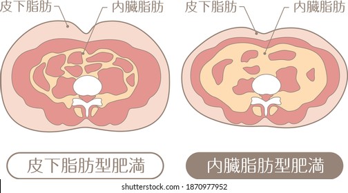 Obesity type

Described in Japanese as "subcutaneous fat", "visceral fat", "subcutaneous fat obesity", and "visceral fat obesity"