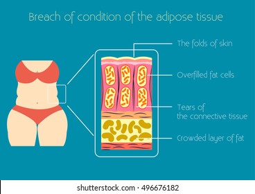 Obesity Vector illustration The structure of adipose tissue by excess body weight and obesity Infographics