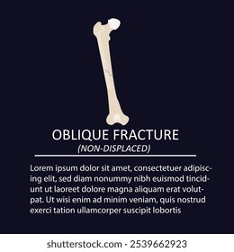 oblique non displaced fracture vector illustration