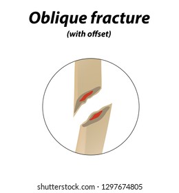 Oblique with offset bone fracture. Infographics. Vector illustration on a lined background.