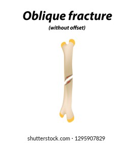 Oblique, without offset bone fracture. Infographics. Vector illustration on a lined background.