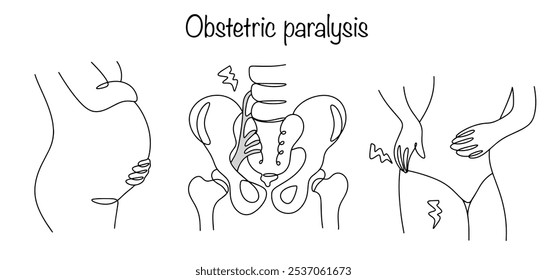 Plexopatia lombossacral materna obstétrica. Uma gestante sente dor após o parto. Pélvis desenhada com dano aos nervos do plexo lombar.