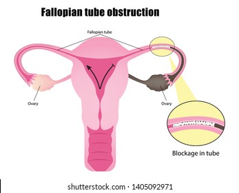 Obstruction of the fallopian tubes, Woman's infertility, vector illustration eps10