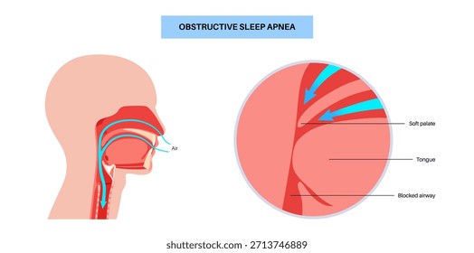 Apnea obstructiva del sueño. Las vías respiratorias colapsan durante el sueño. Pausas en la respiración, ronquidos y caídas de oxígeno. Fatiga y riesgos para la salud. Obstrucción de las vías respiratorias, posición de la lengua y Vector de tratamiento con CPAP