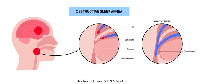 Apnea obstructiva del sueño. Las vías respiratorias colapsan durante el sueño. Pausas en la respiración, ronquidos y caídas de oxígeno. Fatiga y riesgos para la salud. Obstrucción de las vías respiratorias, posición de la lengua y Vector de tratamiento con CPAP