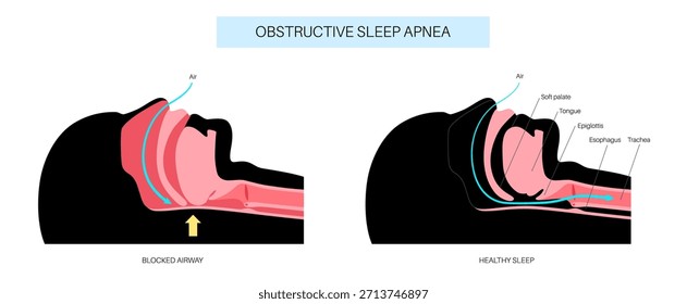 Apnea obstructiva del sueño. Las vías respiratorias colapsan durante el sueño. Pausas en la respiración, ronquidos y caídas de oxígeno. Fatiga y riesgos para la salud. Obstrucción de las vías respiratorias, posición de la lengua y Vector de tratamiento con CPAP