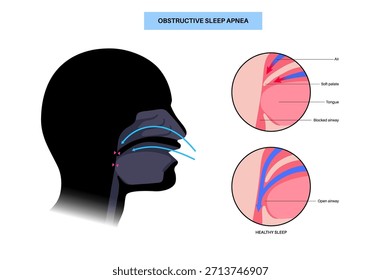 Apnea obstructiva del sueño. Las vías respiratorias colapsan durante el sueño. Pausas en la respiración, ronquidos y caídas de oxígeno. Fatiga y riesgos para la salud. Obstrucción de las vías respiratorias, posición de la lengua y Vector de tratamiento con CPAP