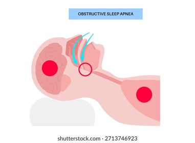 Apnea obstructiva del sueño. Las vías respiratorias colapsan durante el sueño. Pausas en la respiración, ronquidos y caídas de oxígeno. Fatiga y riesgos para la salud. Obstrucción de las vías respiratorias, posición de la lengua y Vector de tratamiento con CPAP