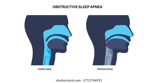 Obstructive sleep apnea. The airway collapses during sleep. Pauses in breathing, snoring, and oxygen drops. Fatigue and health risks. Airway obstruction, tongue position, and CPAP treatment vector