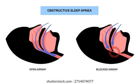 Apnea obstructiva del sueño. Las vías respiratorias colapsan durante el sueño. Pausas en la respiración, ronquidos y caídas de oxígeno. Fatiga y riesgos para la salud. Obstrucción de las vías respiratorias, posición de la lengua y Vector de tratamiento con CPAP