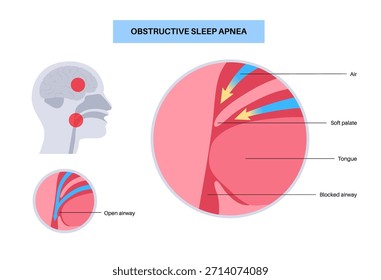 Apnea obstructiva del sueño. Las vías respiratorias colapsan durante el sueño. Pausas en la respiración, ronquidos y caídas de oxígeno. Fatiga y riesgos para la salud. Obstrucción de las vías respiratorias, posición de la lengua y Vector de tratamiento con CPAP