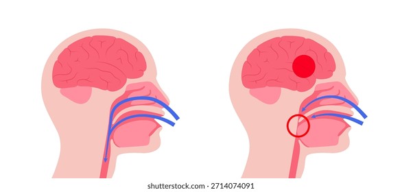 Apnea obstructiva del sueño. Las vías respiratorias colapsan durante el sueño. Pausas en la respiración, ronquidos y caídas de oxígeno. Fatiga y riesgos para la salud. Obstrucción de las vías respiratorias, posición de la lengua y Vector de tratamiento con CPAP