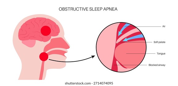 Apnea obstructiva del sueño. Las vías respiratorias colapsan durante el sueño. Pausas en la respiración, ronquidos y caídas de oxígeno. Fatiga y riesgos para la salud. Obstrucción de las vías respiratorias, posición de la lengua y Vector de tratamiento con CPAP