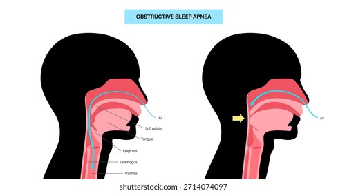 Apnea obstructiva del sueño. Las vías respiratorias colapsan durante el sueño. Pausas en la respiración, ronquidos y caídas de oxígeno. Fatiga y riesgos para la salud. Obstrucción de las vías respiratorias, posición de la lengua y Vector de tratamiento con CPAP