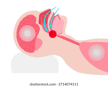 Apnea obstructiva del sueño. Las vías respiratorias colapsan durante el sueño. Pausas en la respiración, ronquidos y caídas de oxígeno. Fatiga y riesgos para la salud. Obstrucción de las vías respiratorias, posición de la lengua y Vector de tratamiento con CPAP