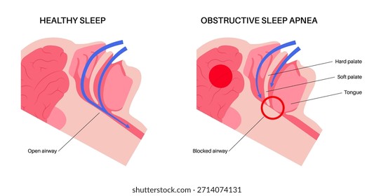 Apnea obstructiva del sueño. Las vías respiratorias colapsan durante el sueño. Pausas en la respiración, ronquidos y caídas de oxígeno. Fatiga y riesgos para la salud. Obstrucción de las vías respiratorias, posición de la lengua y Vector de tratamiento con CPAP