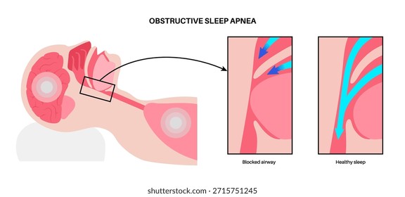 Apnea obstructiva del sueño. Las vías respiratorias colapsan durante el sueño. Pausas en la respiración, ronquidos y caídas de oxígeno. Fatiga y riesgos para la salud. Obstrucción de las vías respiratorias, posición de la lengua y Vector de tratamiento con CPAP