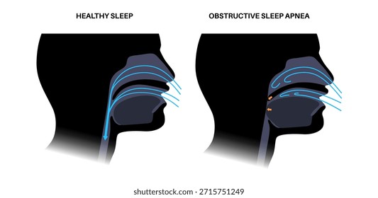 Apnea obstructiva del sueño. Las vías respiratorias colapsan durante el sueño. Pausas en la respiración, ronquidos y caídas de oxígeno. Fatiga y riesgos para la salud. Obstrucción de las vías respiratorias, posición de la lengua y Vector de tratamiento con CPAP