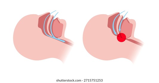 Apneia obstrutiva do sono. As vias aéreas colapsam durante o sono. Pausas na respiração, ronco e gotas de oxigênio. Fadiga e riscos para a saúde. Obstrução das vias respiratórias, posição da língua e vetor de tratamento CPAP