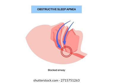 Apnea obstructiva del sueño. Las vías respiratorias colapsan durante el sueño. Pausas en la respiración, ronquidos y caídas de oxígeno. Fatiga y riesgos para la salud. Obstrucción de las vías respiratorias, posición de la lengua y Vector de tratamiento con CPAP