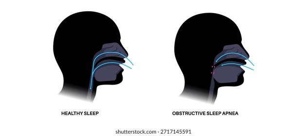Apnea obstructiva del sueño. Las vías respiratorias colapsan durante el sueño. Pausas en la respiración, ronquidos y caídas de oxígeno. Fatiga y riesgos para la salud. Obstrucción de las vías respiratorias, posición de la lengua y Vector de tratamiento con CPAP
