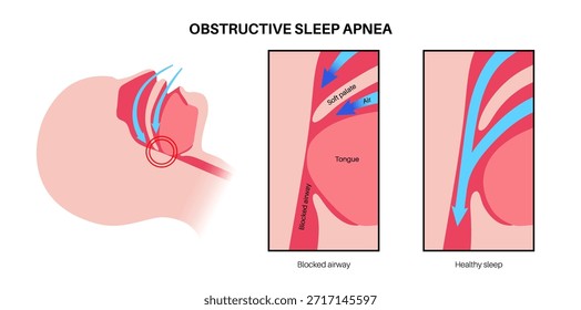 Apnea obstructiva del sueño. Las vías respiratorias colapsan durante el sueño. Pausas en la respiración, ronquidos y caídas de oxígeno. Fatiga y riesgos para la salud. Obstrucción de las vías respiratorias, posición de la lengua y Vector de tratamiento con CPAP