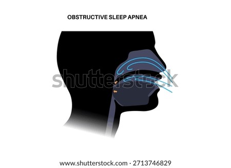 Obstructive sleep apnea. The airway collapses during sleep. Pauses in breathing, snoring, and oxygen drops. Fatigue and health risks. Airway obstruction, tongue position, and CPAP treatment vector