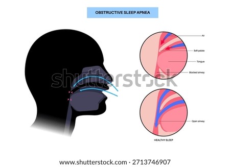 Obstructive sleep apnea. The airway collapses during sleep. Pauses in breathing, snoring, and oxygen drops. Fatigue and health risks. Airway obstruction, tongue position, and CPAP treatment vector