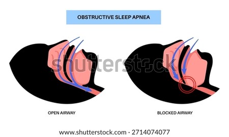 Obstructive sleep apnea. The airway collapses during sleep. Pauses in breathing, snoring, and oxygen drops. Fatigue and health risks. Airway obstruction, tongue position, and CPAP treatment vector