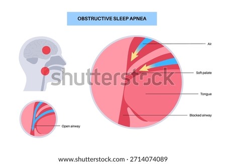 Obstructive sleep apnea. The airway collapses during sleep. Pauses in breathing, snoring, and oxygen drops. Fatigue and health risks. Airway obstruction, tongue position, and CPAP treatment vector