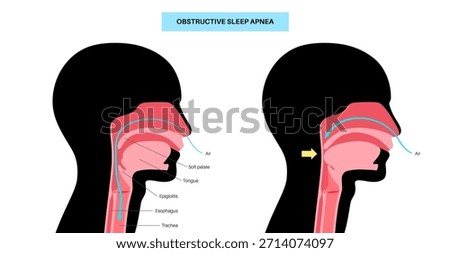 Obstructive sleep apnea. The airway collapses during sleep. Pauses in breathing, snoring, and oxygen drops. Fatigue and health risks. Airway obstruction, tongue position, and CPAP treatment vector