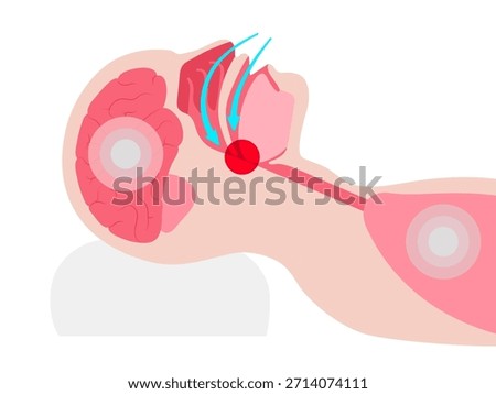 Obstructive sleep apnea. The airway collapses during sleep. Pauses in breathing, snoring, and oxygen drops. Fatigue and health risks. Airway obstruction, tongue position, and CPAP treatment vector