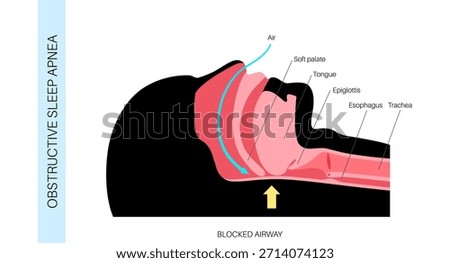 Obstructive sleep apnea. The airway collapses during sleep. Pauses in breathing, snoring, and oxygen drops. Fatigue and health risks. Airway obstruction, tongue position, and CPAP treatment vector