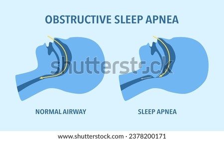 Obstructive sleep apnea concept. Sleep disorder.