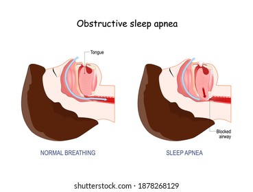 Obstructive Sleep Apnea. normal breathing, and  anatomy of Snoring. Cross section of human's head. Blocked airway with Tongue.