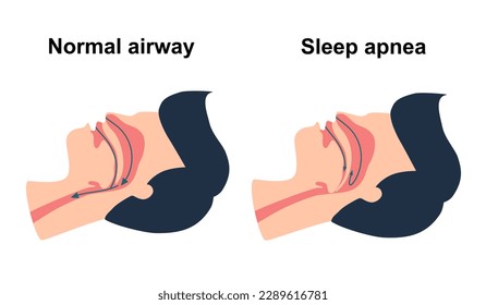 Obstructive sleep apnea syndrome concept vector illustration.