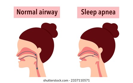 Obstructive sleep apnea syndrome concept vector illustration.