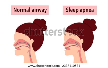 Obstructive sleep apnea syndrome concept vector illustration.