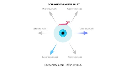 Oculomotor nerve palsy medical poster. Paralysis of the oculomotor nerve, impaired eye movement, ptosis, and double vision. Diplopia disease. Connection with human brain and eye vector illustration