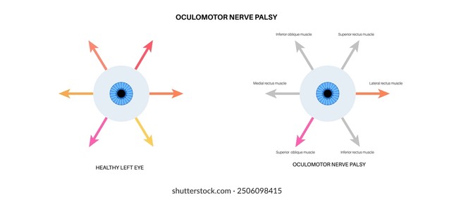 Oculomotor nerve palsy medical poster. Paralysis of the oculomotor nerve, impaired eye movement, ptosis, and double vision. Diplopia disease. Connection with human brain and eye vector illustration