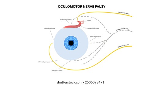 Oculomotor nerve palsy medical poster. Paralysis of the oculomotor nerve, impaired eye movement, ptosis, and double vision. Diplopia disease. Connection with human brain and eye vector illustration