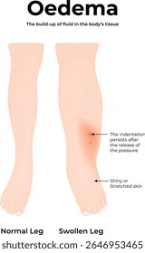 Oedema in the Leg Science Design Vector Illustration Diagram