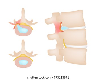 office syndrome / backache / back bone nerve hurt vector