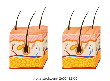Oily and dry skin anatomy. Human body skin vector illustration with parts vein artery hair sweat gland epidermis dermis and hypodermis. Human Cross-section of the skin layers structure