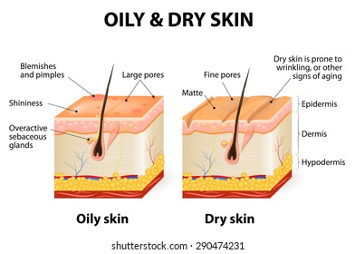 Oily & Dry Skin. Different. Human Skin Types And Conditions. A Diagrammatic Sectional View Of The Skin.