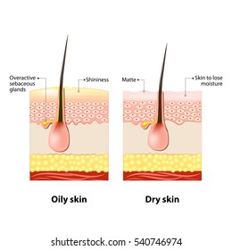 Oily & Dry Skin. Different. Human Skin Types And Conditions. A Diagrammatic Sectional View Of The Skin.