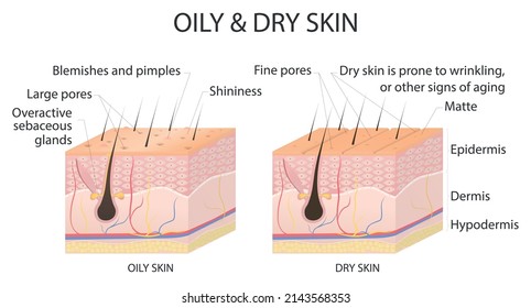 Oily and dry skin. Different types and conditions of human skin. Diagrammatic view of the skin in section. Medical vector illustration.