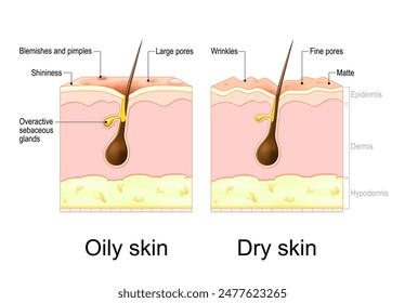 Oily and Dry skin. Skin types. Cross section of a human skin with Wrinkles, pores, blemishes and pimples, hair and sebaceous glands. Vector poster