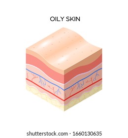 Oily Skin Cross-section Of Human Skin Layers Structure Skincare Medical Concept Flat Vector Illustration