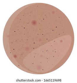 Oily skin with pimples, black dots and greasy Shine. Suitable for dermatology, medicine and cosmetology. Vector illustration on a separate background.